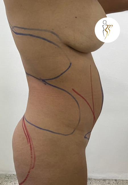 Cirujanos Plásticos en Colombia, Dr. Ronald Ramos, Cirujano Plástico certificado