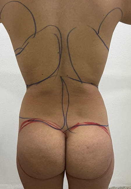 Cirujanos Plásticos en Colombia, Dr. Ronald Ramos, Cirujano Plástico certificado