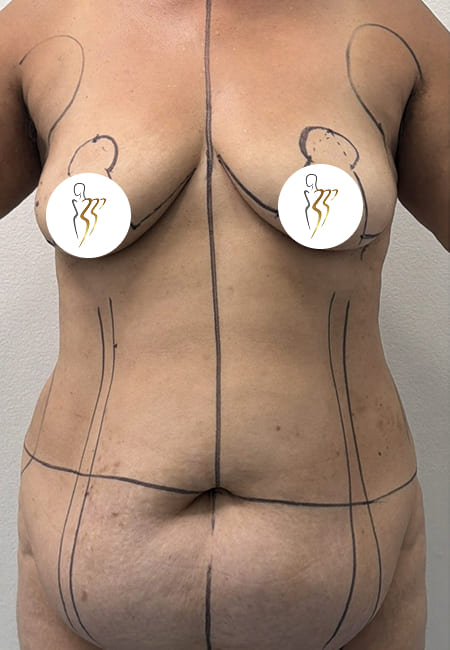 Cirujanos Plásticos en Colombia, Dr. Ronald Ramos, Cirujano Plástico certificado