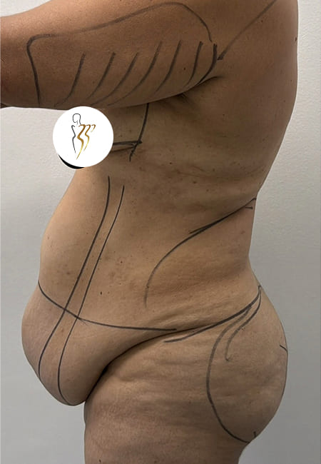 Cirujanos Plásticos en Colombia, Dr. Ronald Ramos, Cirujano Plástico certificado